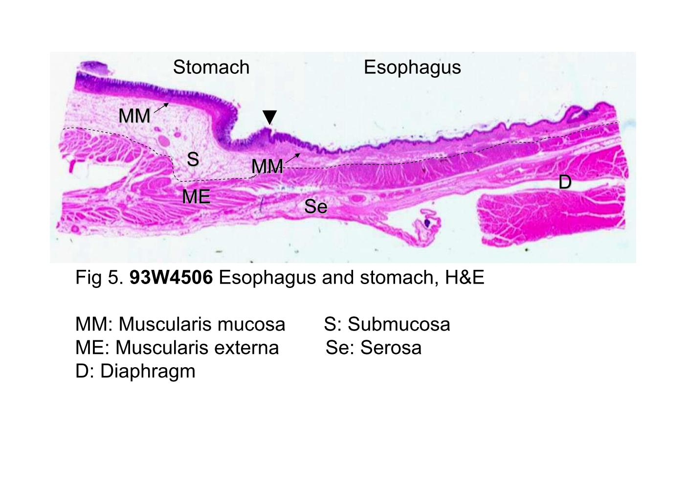 block10-1_13.jpg - Fig 5. 93W4506 Esophagus and stomach, H&E.The junction between the esophagus and stomach is shownhere. The esophagus is on the right, and the cardiac region ofthe stomach is on the left. The arrowhead shows the junction ofthem. The arrows point out the muscularis mucosa (MM) whichis continuous across the junction. The dashed line demonstratesthe boundary of the submucosa (S) and the muscularis externa(ME). The muscularis externa of the distal third esophagusconsists only of smooth muscle. [The skeletal muscle adjacentto the esophagus is the diaphragm (D).] Beneath the muscularisexterna is the serous membrane, serosa (Se), containingvessels and nerve fiber bundles.