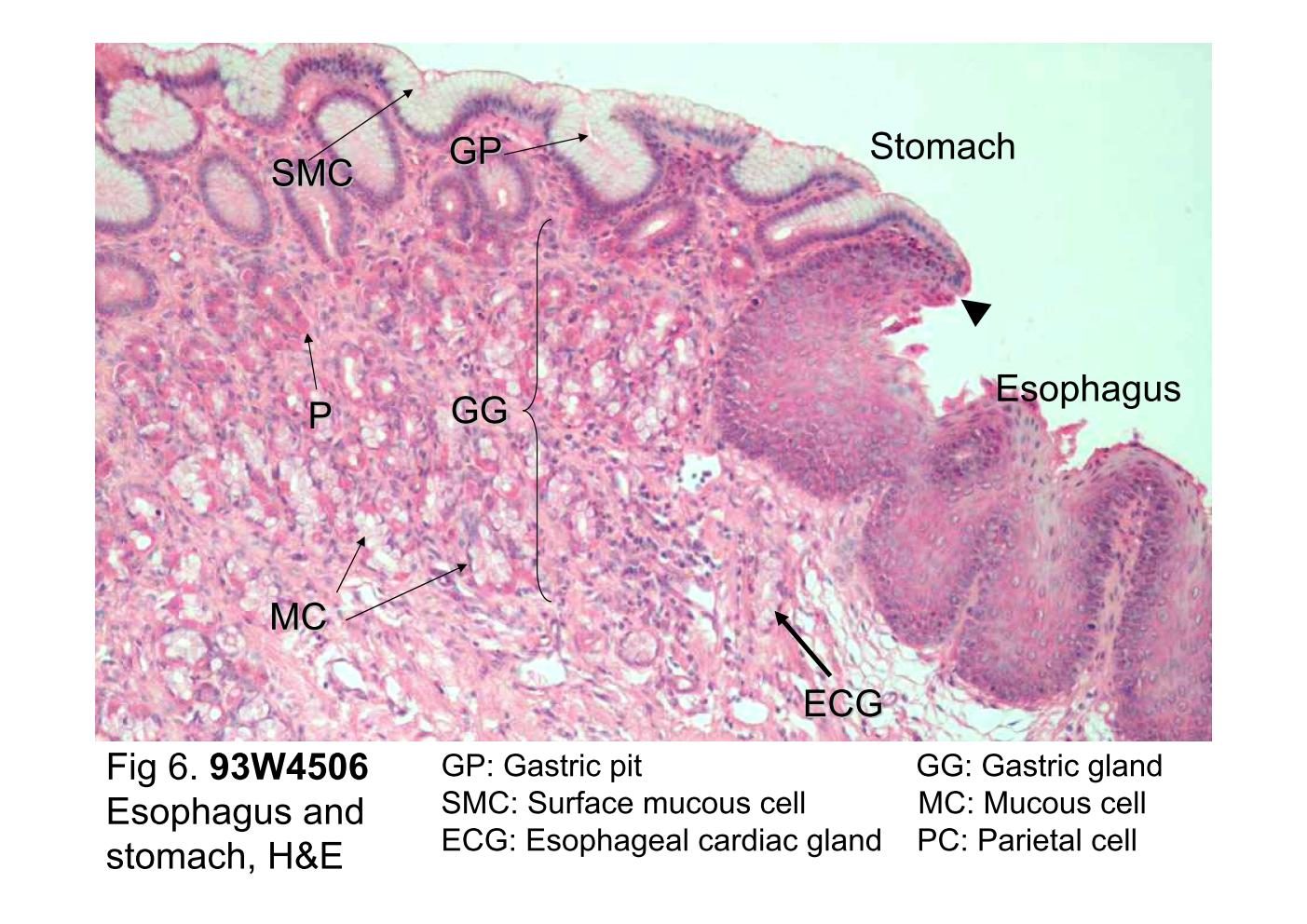 block10-1_15.jpg - Fig 6. 93W4506 Esophagus-stomach junction.At the junction of the esophagus with the stomach, the stratifiedsquamous epithelium of the esophagus ends abruptly, and thesimple columnar epithelium of the stomach mucosa begins. Thearrowhead shows the junction of them. The surface of thestomach contains pale-stained surface mucous cells (SMC).The surface of the stomach also contains numerous andrelatively deep depressions called gastric pits (GP) that areformed by surface mucous cells. Esophageal cardiac glands(ECG) are named for their similarity to the cardiac glands of thestomach. They are present in the terminal part of theesophagus and occur in the lamina propria of the mucosa.This slide is taken from a mammal but not human, hence thehistological features of its gastric glands are somewhat unlikehuman's. The gastric glands (GG) of this species containsabundant mucous cells (MC) and parietal cells (PC).