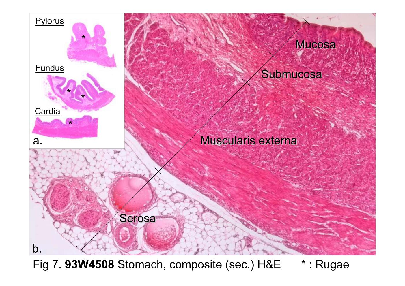 block10-1_17.jpg - Fig 7. 93W4508 Stomach, composite (sec.) H&E.Three regions of the stomach are shown in this slide: upper,pylorus; middle, fundus; lower, cardia (as shown in Fig 7a).As with other parts of the gastrointestinal tract, the wall of thestomach consists of four layers: a mucosa, a submucosa, amuscularis externa, and a serosa. The inner surface of theempty stomach is thrown into long folds referred to as rugae (*).Several such cross-sectioned folds are shown in Fig 7a. Theyconsist of mucosa and submucosa. The rugae are notpermanent folds; they disappear when the stomach wall isstretched, as in the distended stomach.