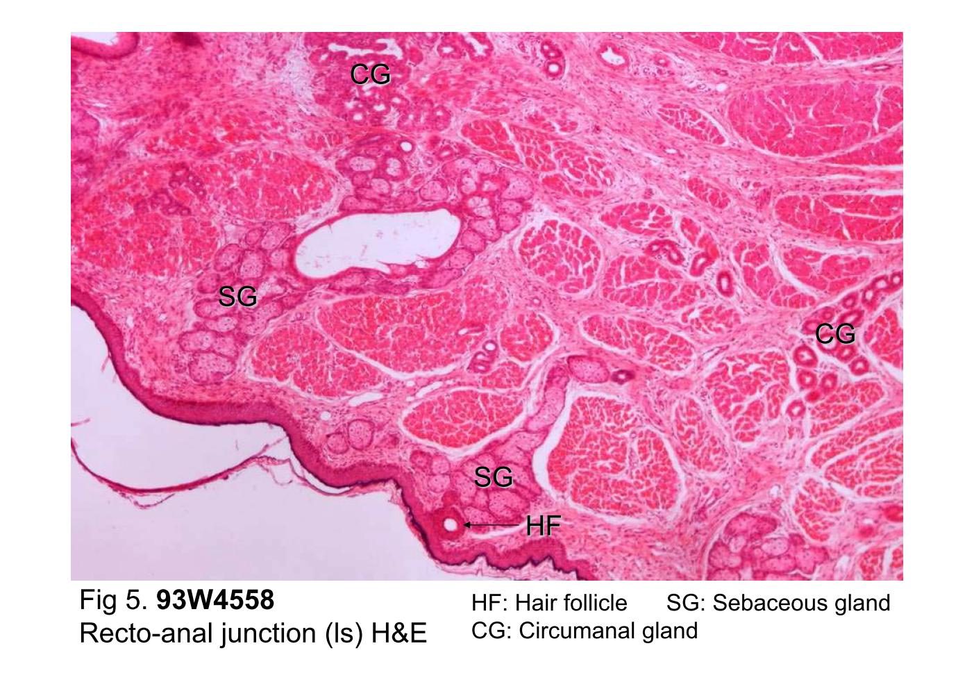 block10-2_13.jpg - Fig 5. 93W4558, Recto-anal junction (ls) H&E.The right side of this slide is the keratinized stratified squamousepithelium of skin. The dermis of the skin contains hair follicles(HF), sebaceous gland (SG) and circumanal glands (CG). Themicroscopic characteristics of the skin will be described in thenext semester.