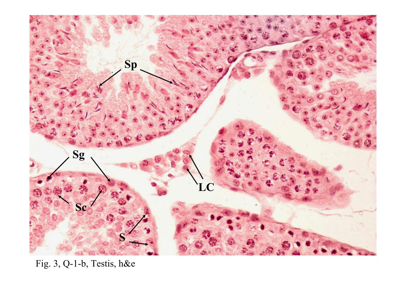 block14_08.jpg - Fig. 3 & 4, Q-1-b, Testis, h&e; 93W7206, Testis, ihExamination of the tubule epithelium reveals two kinds of cells: a  proliferating population of spermatogenic cells and a non-proliferating  population, the Sertoli cells (S). The Sertoli cells are considerably fewer  and can be recognized by their elongate, trangular, pale-staining nuclei  and conspicuous nucleolus. The Sertoli cell extends from the periphery of  the tubule to the lumen. The spermatogenic cells consist of successive  generations arranged in concentric layers. The spermatogonia (Sg) are  found at the periphery. The spermatocytes (Sc), most of them have large  round nuclei with a distinctive chromatin pattern, come to lie above the  spermatogonia. The spermatid (Sp) consists of one or two generations and  occupies the site closest to the lumen.In high magnification, it reveals a population of Leydig cells (LC) that occur  in small clusters and lie in the interstitial space between adjacent tubules.  They are readily identified by their location, small round nucleus and  eosinophilic cytoplasm.