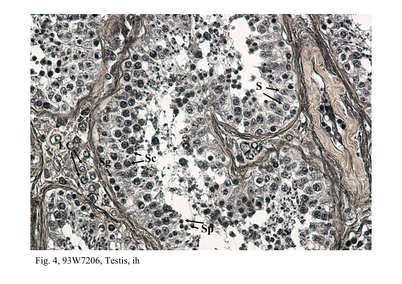 block14_09.jpg - Fig. 3 & 4, Q-1-b, Testis, h&e; 93W7206, Testis, ihExamination of the tubule epithelium reveals two kinds of cells: a  proliferating population of spermatogenic cells and a non-proliferating  population, the Sertoli cells (S). The Sertoli cells are considerably fewer  and can be recognized by their elongate, trangular, pale-staining nuclei  and conspicuous nucleolus. The Sertoli cell extends from the periphery of  the tubule to the lumen. The spermatogenic cells consist of successive  generations arranged in concentric layers. The spermatogonia (Sg) are  found at the periphery. The spermatocytes (Sc), most of them have large  round nuclei with a distinctive chromatin pattern, come to lie above the  spermatogonia. The spermatid (Sp) consists of one or two generations and  occupies the site closest to the lumen.In high magnification, it reveals a population of Leydig cells (LC) that occur  in small clusters and lie in the interstitial space between adjacent tubules.  They are readily identified by their location, small round nucleus and  eosinophilic cytoplasm.