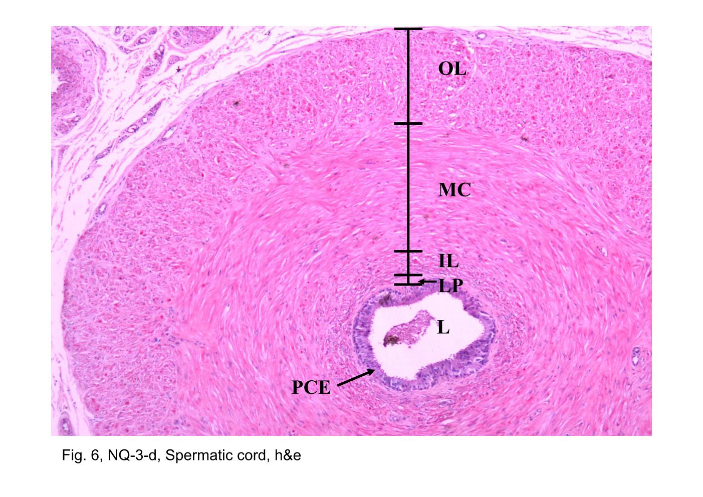 block14_13.jpg - Fig. 6 & 7, NQ-3-d, Spermatic cord, h&eThe ductus deferens and some of the blood vessels (BV), nerves (N) and  cremaster muscles (CM) accompaning the duct in the spermatic cord are  shown in this cross section. The wall of the ductus deferens is extremely  thick, mostly because of the presence of abundent smooth muscle. During  the preparation of the tissue, The muscle contracted and caused the  mucosa to form longitudinal folds. For this reason, the lumen (L) usually  appears irregular in the section.The smooth muscle of the ductus deferens is arranged as a thick outer  longitudinal layer (OL), a thick middle circular layer (MC), and a thin  inner longitudinal layer (IL). The epithelial lining of the ductus deferens  consists of the pseudostratified columnar epithelium (PCE). Between the  epithelium and the inner longitudinal smooth muscle layer, there is a  cellular layer of loose connective tissue, the lamina propria (LP).