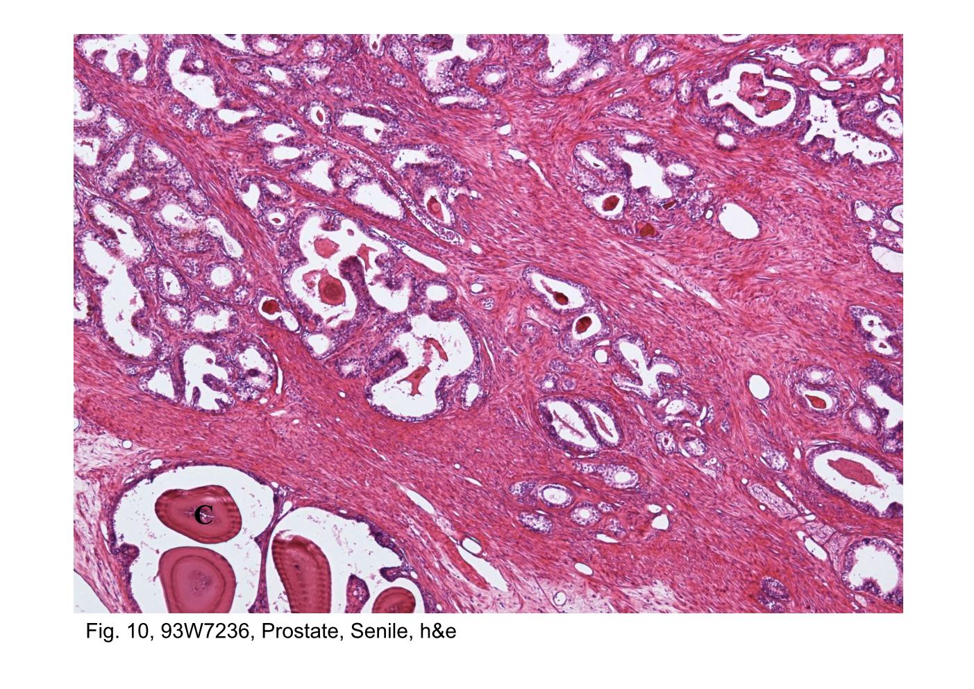 block14_19.jpg - Fig. 10, 93W7236, Prostate, Senile, h&eA portion of the prostate gland is shown in this low-magnification  micrograph. The field is filled with the glandular and stromal  components of the prostate gland. The secretory tubuloalveoli of  the prostate gland vary greatly in form. They may appear as tubes,  as isolated alveoli, as alveoli with branches, or as tubes with  branches. The aggregations of dead epithelial cells and precipitated  secretions form prostatic concretions (C) in the lumina of the  alveoli; these gradually increase in number and size with age. The  concretions is eosinophilic and may have a concentric lamellar  appearance.