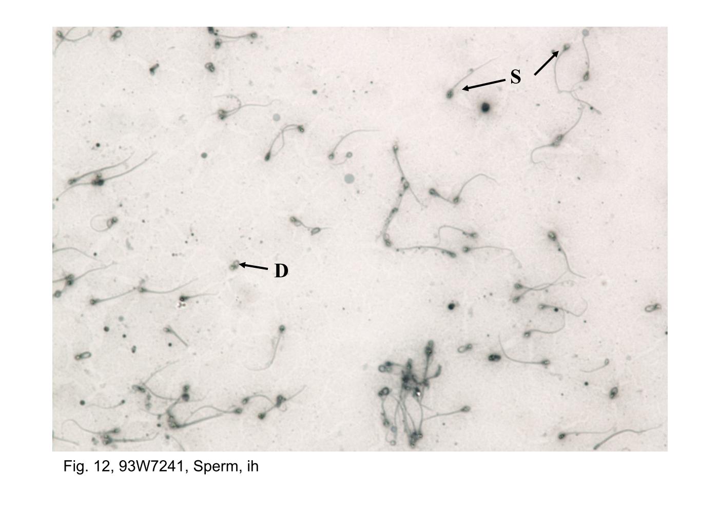 block14_23.jpg - Fig. 12, 93W7241, Sperm, ih (Semen smear)Semen, the product of ejaculation, consists of spermatozoa (S) and  seminal fluid which is derived principally from the seminal vesicles  and prostate gland. The desquamated cells (D) and urinary tract  debris are normal constituents of semen.