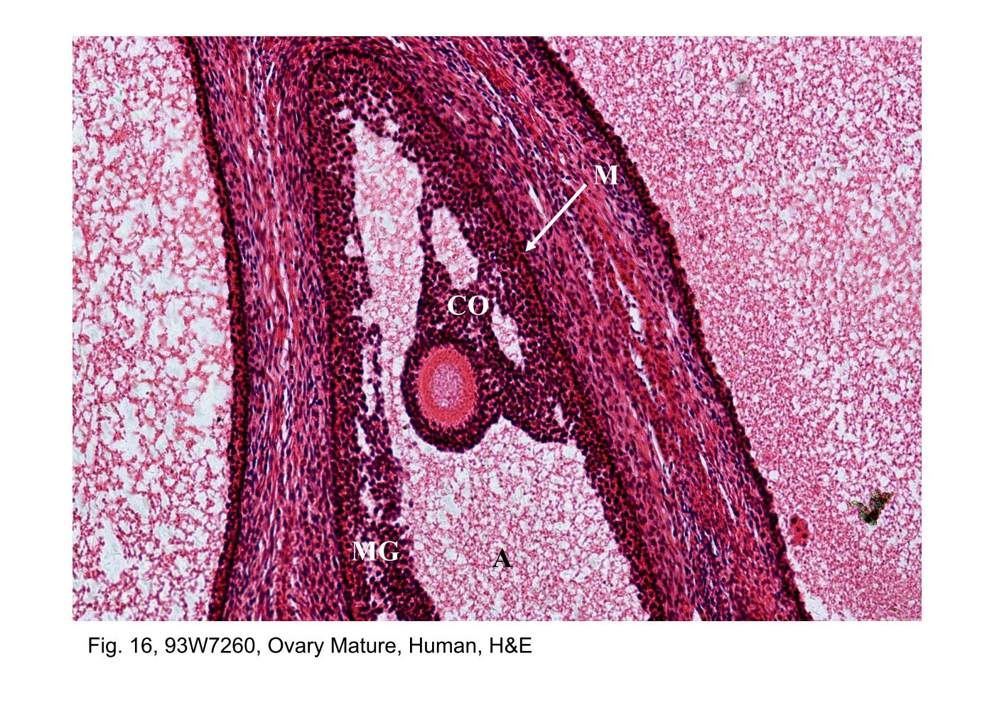 block14_31.jpg - Fig. 16, 93W7260, Ovary Mature, Human, H&EA stage in the growth of the mature (Graafian) follicle (M) is shown  here. The antrum (A) is larger, and the oocyte is off to one side,  surrounded by a mound of follicular cells called the cumulus  oophorus (CO). The remaining follicular cells that surround the  antral cavity are referred to as the membrana granulosa (MG).The atretic follicles (AF) are shown in figure 15. They can be  identified by virtue of the retained zona pellucida (ZP).