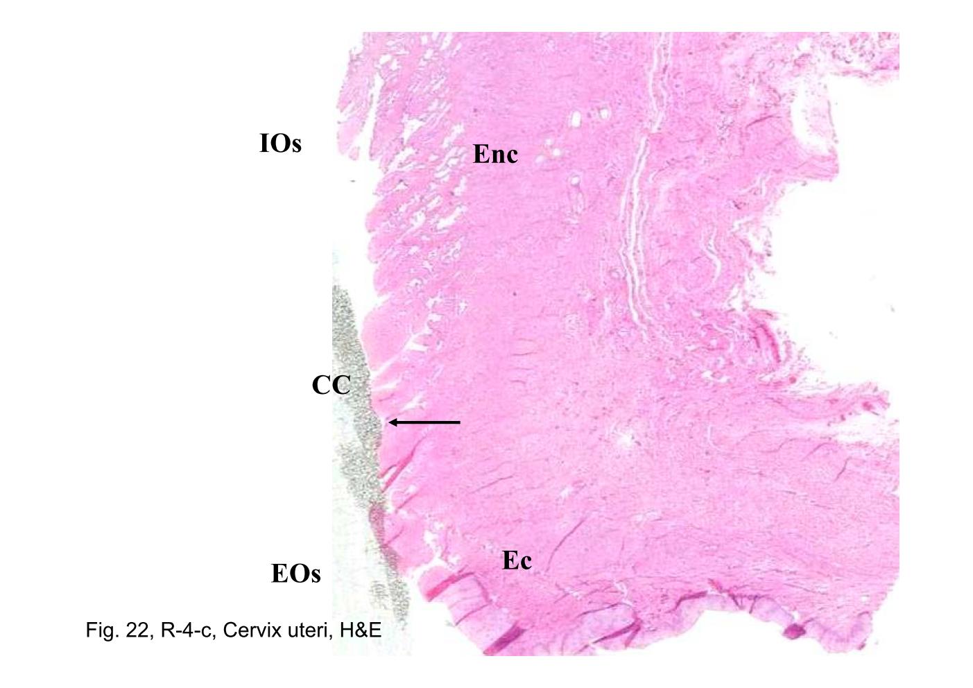block14_43.jpg - Fig. 22, R-4-c, Cervix uteri, H&EThe portion of the cervix that projects into the vagina, the ectocervix  (Ec), is covered with a stratified squamous epithelium. An abrupt  transition (arrow) from this squamous epithelium to columnar  epithelium, the endocervix (Enc), occurs at the entry to the cervical  canal (CC). The upper end, the internal os (IOs), communicates  with the uterine cavity, and the lower end, the external os (EOs),  communicates with the vagina.