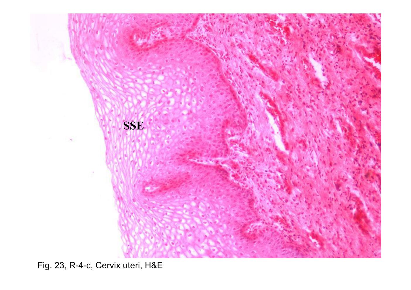 block14_45.jpg - Fig. 23, R-4-c, Cervix uteri, H&EThe surface of the ectocervix is stratified squamous epithelium (SSE). The epithelium-connective tissue junction presents a relatively even contour in contrast to the irregular profile seen in the vagina. In other respects, the epithelium has the same general features as the vaginal epithelium. The mucosa of the ectocervix, like that of the vagina, is devoid of glands.