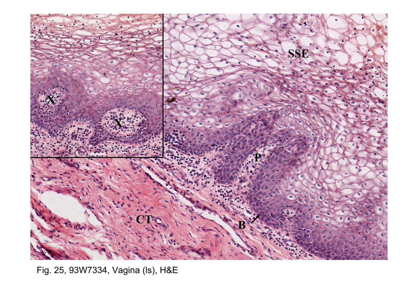 block14_49.jpg - Fig. 25, 93W7334, Vagina (ls), H&EThe mucosa of the vagina consists of a stratified squamous epithelium (SSE)   and an underlying fibrous connective tissue (CT) that often appears more   cellular than other fibrous connective tissue. The boundary between the   two is readily identified because of the conspicuous staining of the   closely packed small cells of the basal layer (B) of the epithelium.   Connective tissue papillae (P) project into the underside of the epithelium,   giving the epithelial-connective tissue junction an uneven appearance.   The papillae may be cut obliquely or in cross section and thus may   appear as connective tissue islands (arrows; insert). The epithelium is   characteristically thick and although keratohyaline granules may be   found in the superficial cells, keratinization does not occur in human   vaginal epithelium. Thus, nuclei can be observed throughout the entire   thickness of the epithelium despite the fact that the cytoplasm of most of   the cells above the basal layers appears empty. These cells are normally   filled with large deposits of glycogen that is lost in the processes of   fixation and embedding of the tissue.