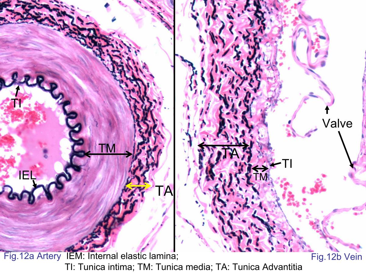 block4_24.jpg - Fig.12a Photomicrograph of muscular artery. The arteryhas a thicker tunica media, a narrower lumen than thesimilarly sized vein, and thickened elastic laminae not presentin the vein. The characteristics are described in figure 10.Fig.12b Photomicrograph of medium-sized vein.The vein, by contrast, has a thicker tunica adventitia, a widerlumen, and valves. The tunica intima consists of endotheliumand a very thin subendothelial layer of connective tissue. Thevalve consists of projections of the tunica intima of the veinwall; the projections are lined on both sides by endothelium.The tunica media contains circularly and spirally arrangedsmooth muscle cells. The tunica adventitia contains anabundance of collagen (pink) and elastic fibers (black).