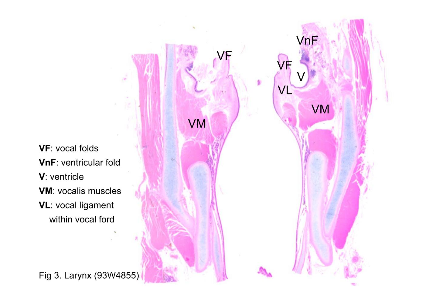 block9_09.jpg - Fig 3. Larynx (93W4855)The two vocal folds (VF) and the space between them constitute the glottis. Just above each vocal fold is an elongated recess called the ventricle (V), and above the ventricle is another ridge called the ventricular fold (VnF) or, sometimes, the false vocal fold. Below and lateral to the vocal folds are the vocalis muscles (VM). The elastic material is a component of the vocal ligament (VL).