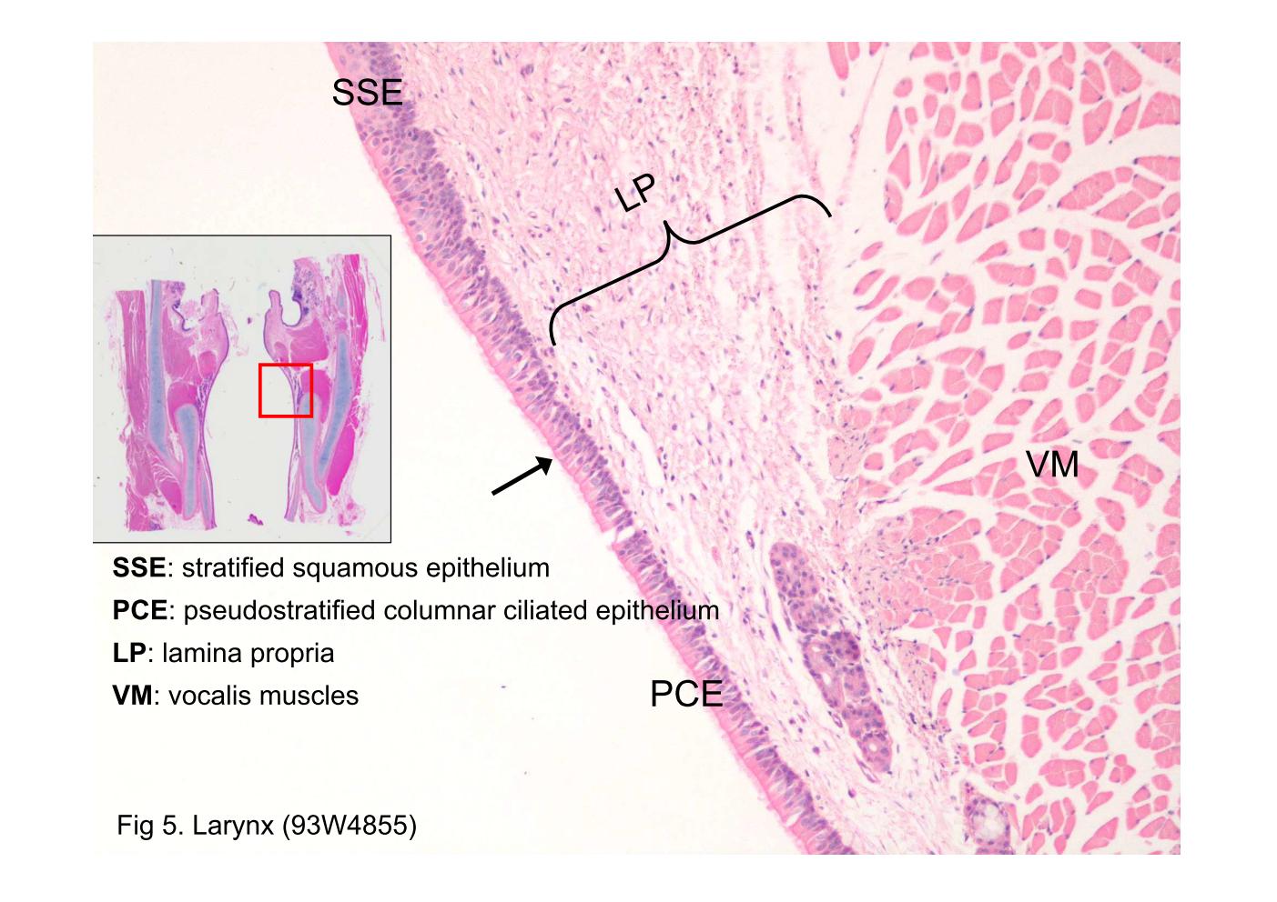 block9_13.jpg - Fig 5. Larynx (93W4855)It shows the lateral surfaces and lower part of the vocal fold. The arrow shows an interface between the stratified squamous epithelium (SSE), with its flat surface cells, and the pseudostratified columnar ciliated epithelium (PCE), with its columnar surface cells, is present. The lamina propria (LP) consists of loose connective tissue. Adjacent to the lamina propria the vocalis muscles (VM) can be observed.