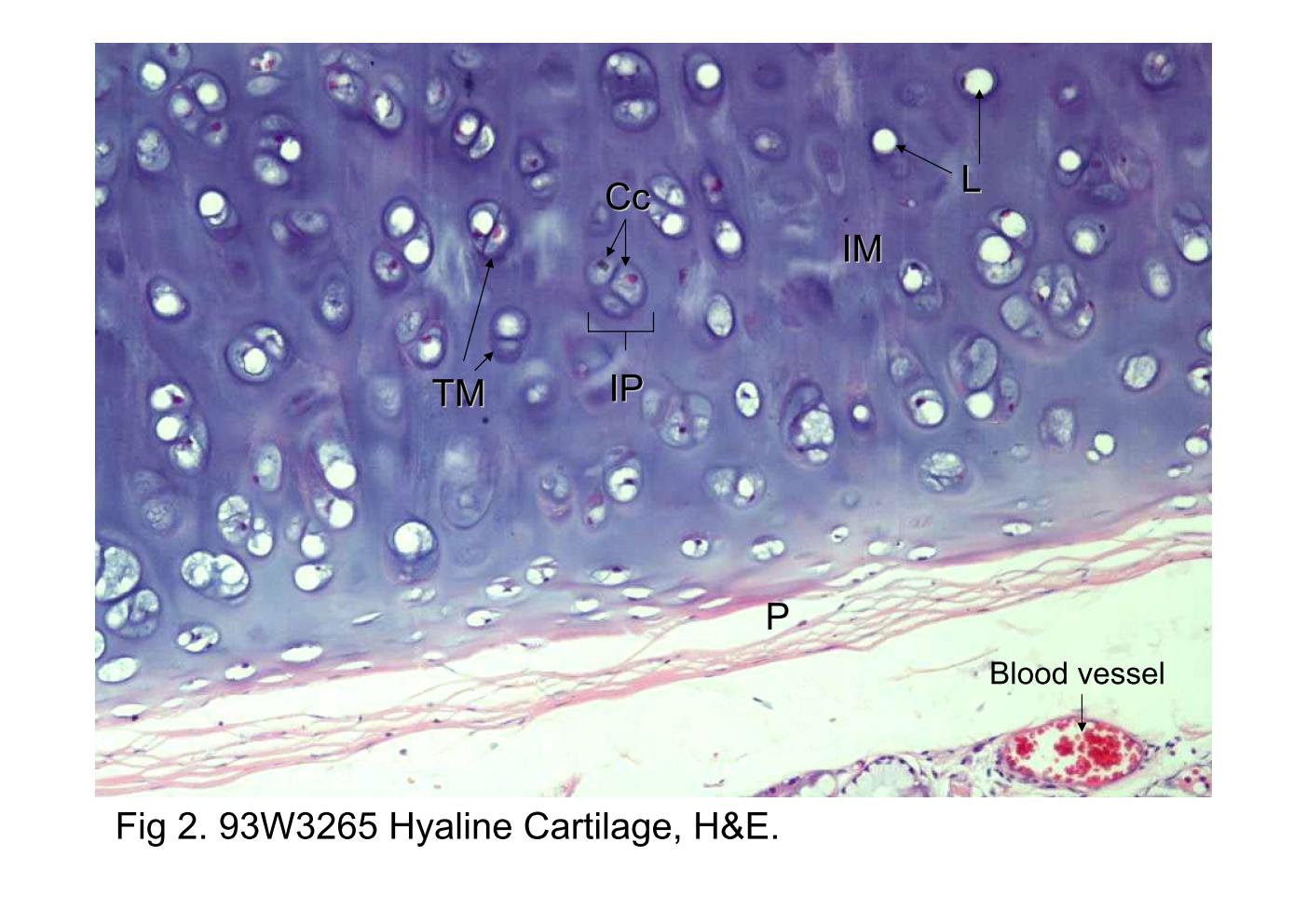 block6-1_07.jpg - Fig 2. 93W3265 Hyaline Cartilage, H&E.This figure shows a higher-magnification micrograph of a hyalinecartilage with its perichondrium (P). The cartilage appears as anavascular expanse of matrix material and a population of cellscalled chondrocytes (Cc). The chondrocytes produce the matrix;the space each chondrocyte occupies is called a lacuna (L).Hyaline cartilage is surrounded by a thin layer of denseconnective tissue, the perichondrium. The perichondrium servesas a source of new chondrocytes during appositional growth ofthe cartilage. Chondrocytes also undergo interstitial growth inlacunae and form isogenous groups (IP). The chondrocytesproduce the cartilage matrix that shows the dark-staining capsuleor territorial matrix (TM) immediately surrounding the lacunae.The interterritorial matrix (IM) is more removed from theimmediate vicinity of chondrocytes and is less intensely stained.