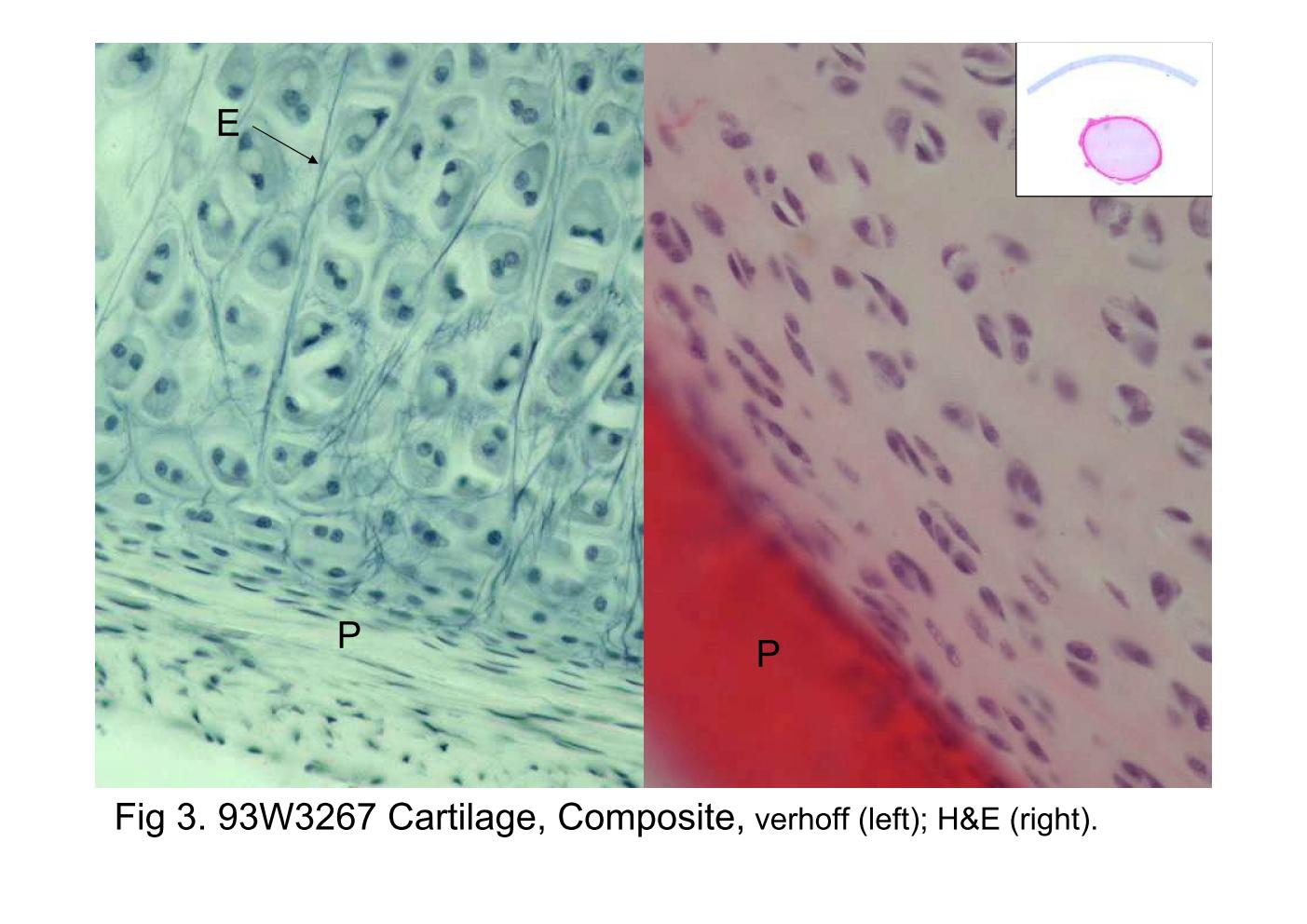 block6-1_09.jpg - Fig 3. 93W3267 Cartilage, Composite,        verhoff (left) H&E (right).There are two sections in this slide (inset): upper one is elasticcartilage and lower one is hyaline cartilage. These sections aretaken from young, growing cartilages and both of them aresurrounded by the perichondrium (P). The mainly distinguishedfeature of hyaline and elastic cartilages is the elastic fibers (E),which are only found in elastic cartilage. The commonhistological structure of elastic cartilage is similar to that ofhyaline cartilage, its elasticity, however, being derived from thepresence of numerous bundles of branching elastic fibres in thecartilage matrix.