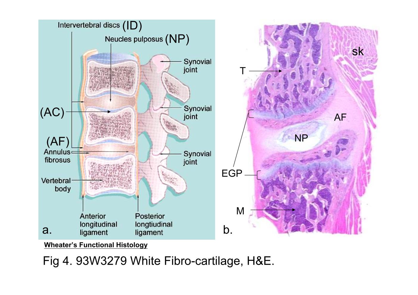 block6-1_11.jpg - Fig 4a. The intervertebral jointsThe intervertebral disc (ID) lies between the adjacent vertebralbodies. The articular surface of vertebral body is covered byhyaline articular cartilage (AC). The fibrocartilage of eachintervertebral disc is arranged in concentric rings forming theannulus fibrosus (AF). Within the disc, there is a central cavitycontaining a viscous fluid, the nucleus pulposus (NP).Fig 4b. 93W3279 White Fibro-cartilage (sec.) H&E.This section is prepared from the developing vertebral column.Except the structures mentioned above, the skeletal muscle (sk)and the epiphyseal growth plates (EGP) can be identified. In thislow power photomicrograph, the vertebral bodies have beenpartially replaced by bone trabeculae (T), and the bone cavity isfilled with bone marrow (M).