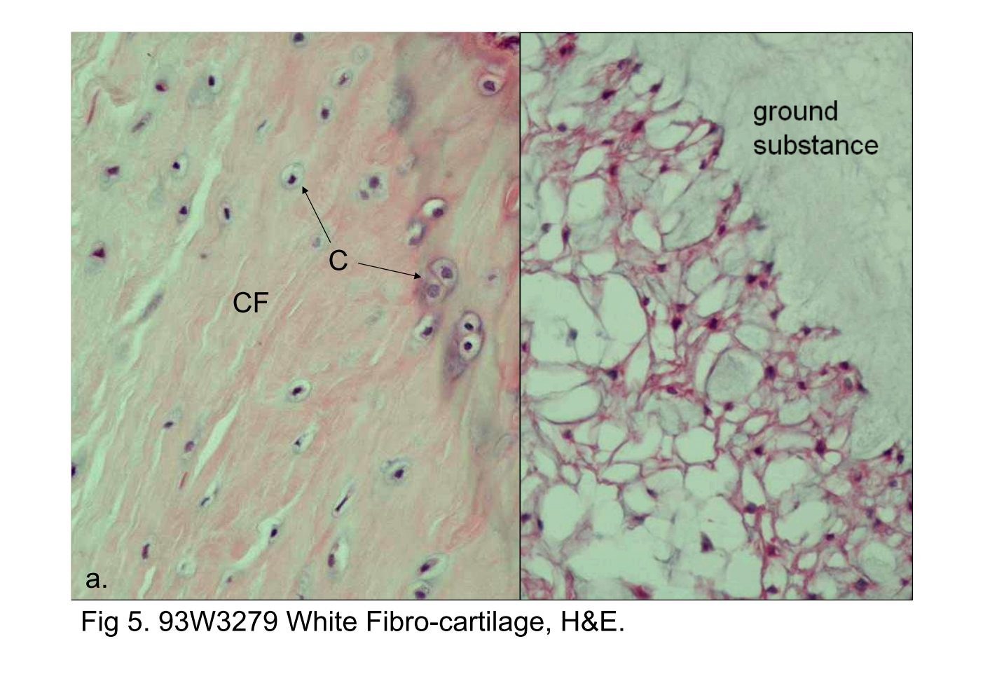 block6-1_13.jpg - Fig 5. 93W3279 White Fibro-cartilage, H&E.Fibrocartilage is a combination of dense regular connectivetissue and hyaline cartilage. The chondrocytes (C) are dispersedamong the collagen fiber bundles (CF) (Fig 5a).Fig 5b shows the histological structures in the nucleus pulposus.It is composed of ground substance and physaliphorous cells.