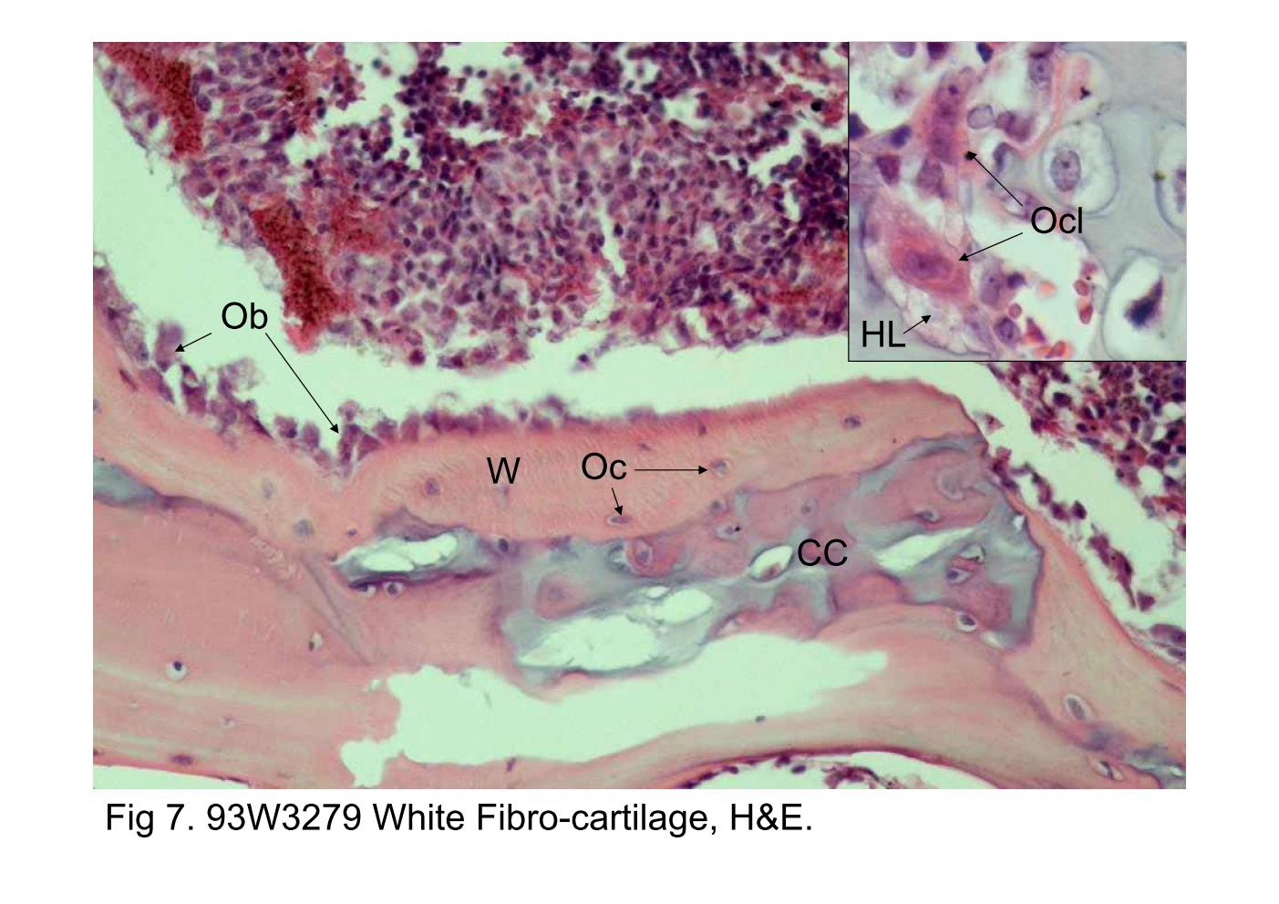 block6-1_17.jpg - Fig 7. 93W3279 White Fibro-cartilage, H&E.The blue-stained spicules of calcified cartilage (CC) aresurrounded by active osteoblasts (Ob) and newly formedwoven bone (W), which is stained pink. The osteocytes (Oc)are embedded in the bone matrix. The inset reveals two large,multinucleated osteoclasts (Ocl) and the underlying absorptivespace, Howship's lacunae (HL), is also identified.