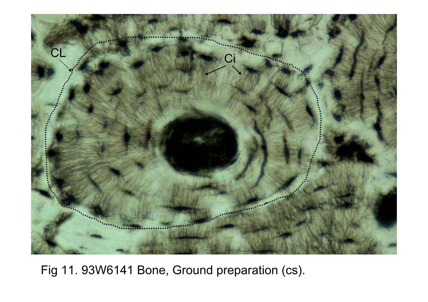 block6-1_25.jpg - Fig 11. 93W6141 Bone, Ground preparation (cs).Note the lacunae and the fine thread-like profiles emanatingfrom the lacunae. These thread-like profiles represent thecanaliculi (Ci). They are spaces within the bone matrix thatcontain cytoplasmic processes of the osteocyte. The canaliculiof each lacuna communicate with these of neighboringlacunae to form a three-dimensional channel systemthroughout the bone. Cement line (CL) is the outer limits of anewly formed osteon.